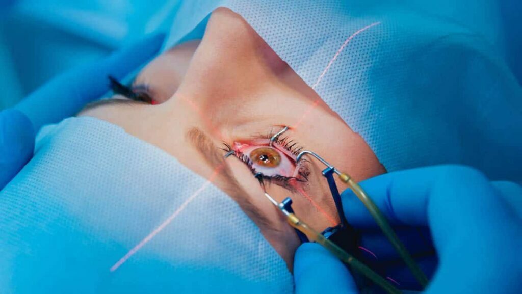 Opération myopie : Choisir le LASIK ou la PKR