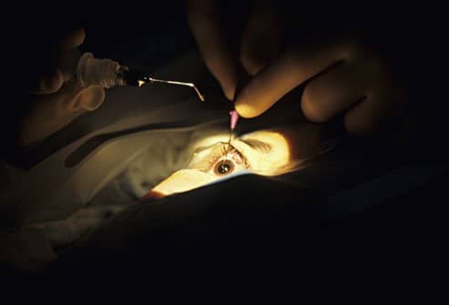 Chirurgie de la cataracte