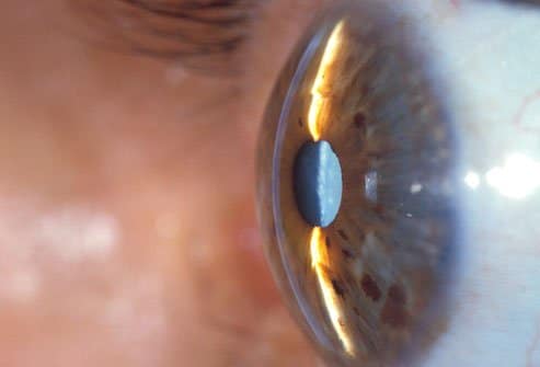 Comment la cataracte est-elle diagnostiquée ?