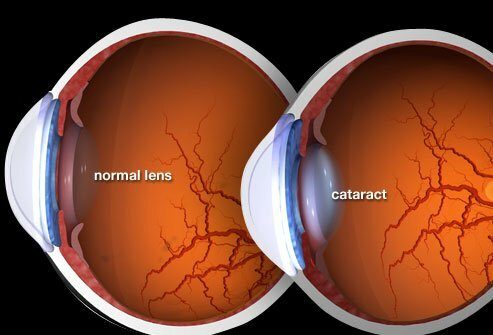 Comment les cataractes affectent votre vision