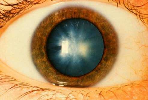 Quelles sont les causes de la cataracte ?