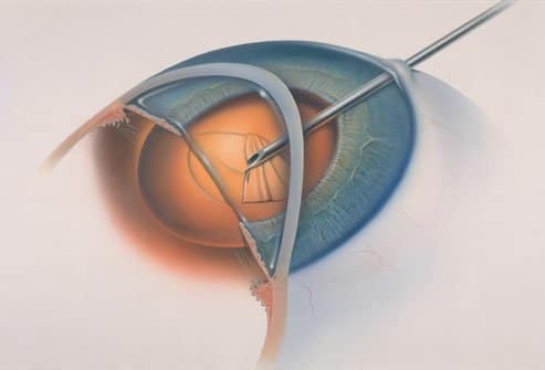 Types de chirurgie de la cataracte